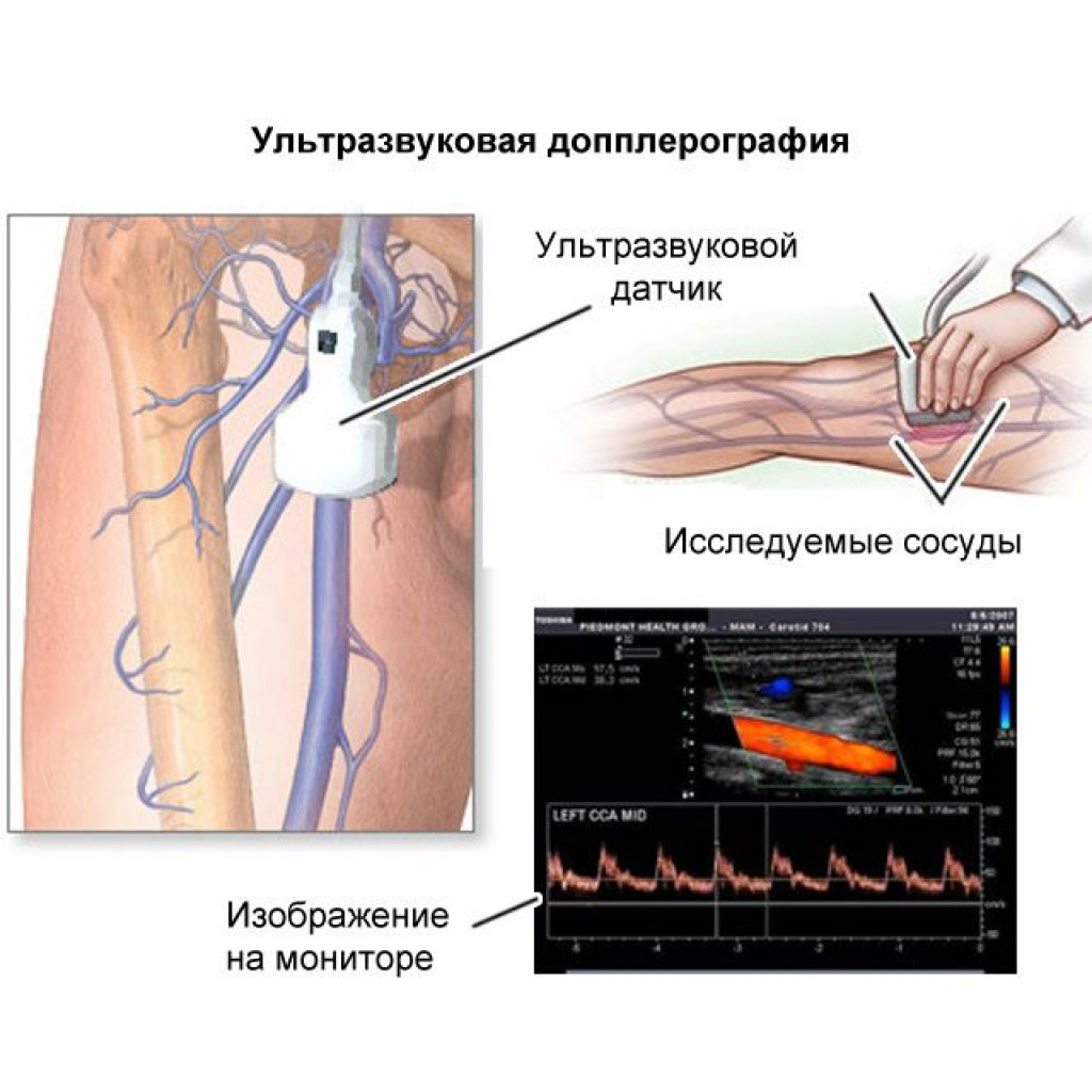 ультразвуковая допплерография головы шеи